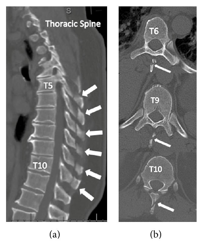 Sagittal and axial CT showing isolated T5 to T10 thoracic spinous process fractures