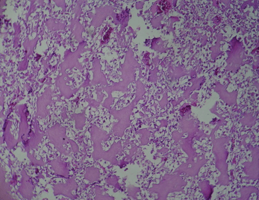 Photomicrograph showing bone formation within clear cell chondrosarcoma tissue.