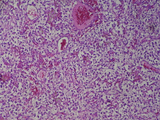 Photomicrograph of sheets of tumour cells with clear cytoplasm and distinct cell borders.