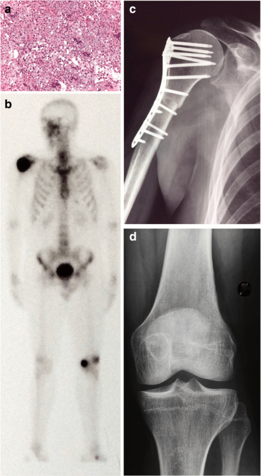 Radiograph, axial CT and T2-weighted MRI of a well-defined lytic femoral condylar lesion with a sclerotic rim.
