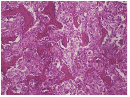 Photomicrograph of a typical clear cell chondrosarcoma area from an original tumour specimen.