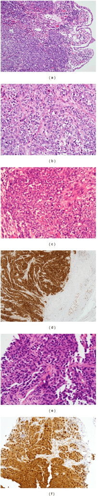 Six-panel histopathology and immunohistochemistry of a clear cell sarcoma family tumour with nested epithelioid cells