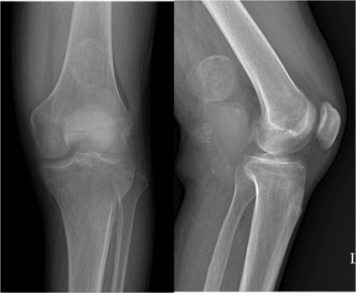 Two-panel knee radiograph showing a well-defined soft tissue mass with marginal calcification posterior to the distal femur