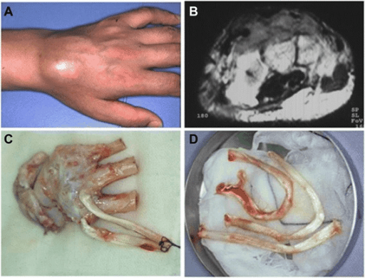 Clinical swelling, axial MRI and resection specimen from clear cell sarcoma of the dorsal wrist