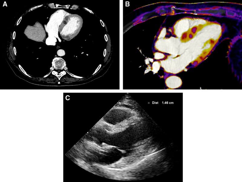 CT iodine map and echocardiography showing myocardial metastases from clear cell sarcoma