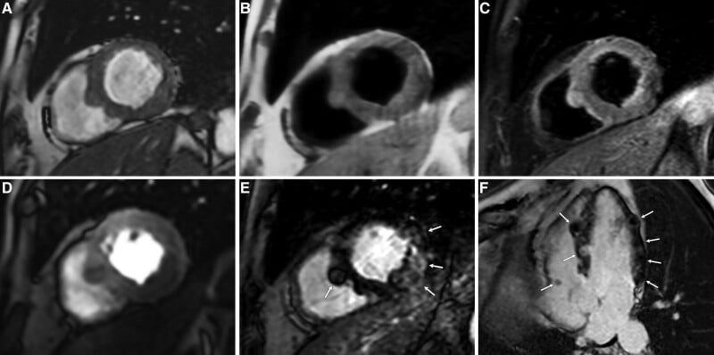 Multiparametric cardiac MRI showing nodular myocardial metastases from clear cell sarcoma