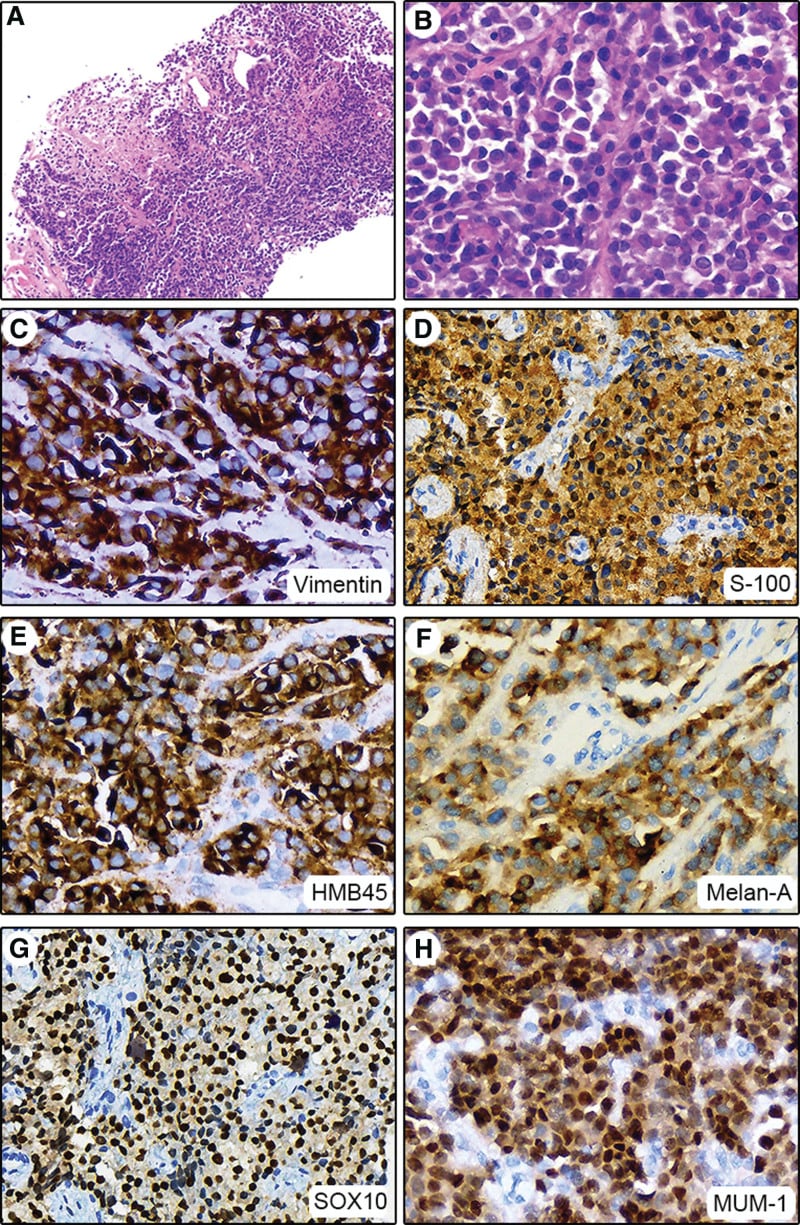 Clear cell sarcoma histology with S100, HMB45, Melan-A and SOX10 immunohistochemistry