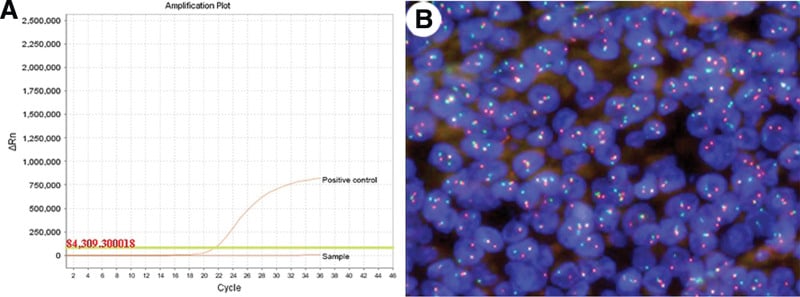 Wild-type BRAF amplification plot and EWSR1 break-apart FISH in clear cell sarcoma