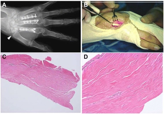 Carpal collapse and irradiated tendon histology after limb-salvage reconstruction for wrist clear cell sarcoma