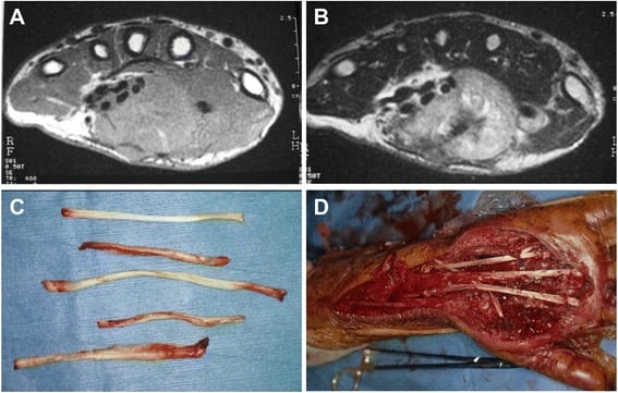 Axial MRI, resected tendons and reconstruction of clear cell sarcoma spanning the palm