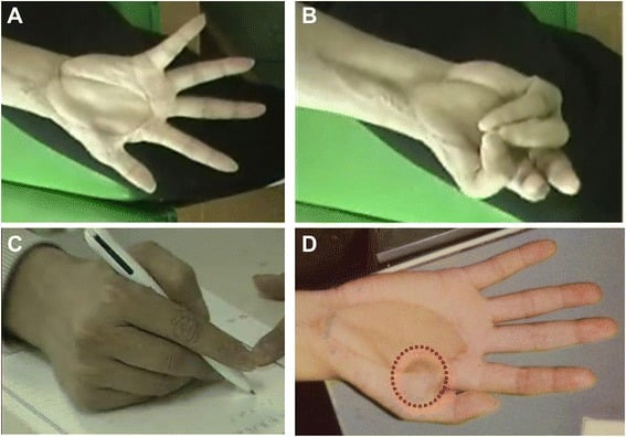 Hand function and local recurrence after tendon reconstruction for clear cell sarcoma of the palm