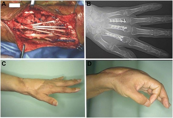 Operative wrist reconstruction, postoperative fixation and hand function after wide clear cell sarcoma excision