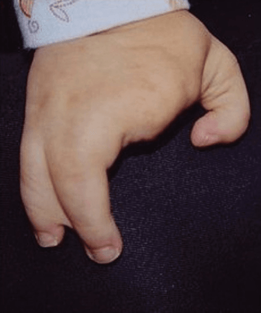 Split hand malformation (ectrodactyly, i.e. missing fingers) of the right hand (image from Wikipedia). The 4th and 5th fingers are partly united, an anomaly called syndactyly malformation.