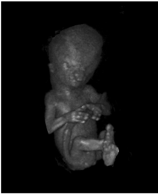3D transvaginal ultrasound dataset of a fetus with an ectrodactyly ectodermal dysplasia-cleft (EEC) syndrome visualized in Virtual Reality. Bilateral split hands and split feet are seen as well as bil