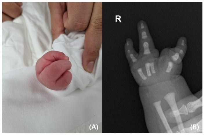 Clinical photograph and AP radiograph of a right hand with tetradactylous ectrodactyly.