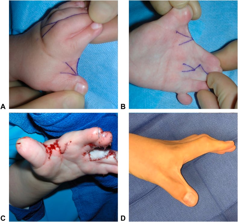Four-panel sequence showing dorsal and volar markings, closure and long-term result of first-web four-flap Z-plasty.