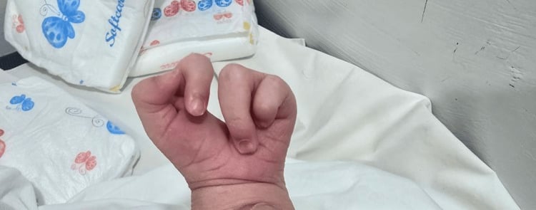 Left neonatal hand with absence of the middle digit and a narrower central cleft.