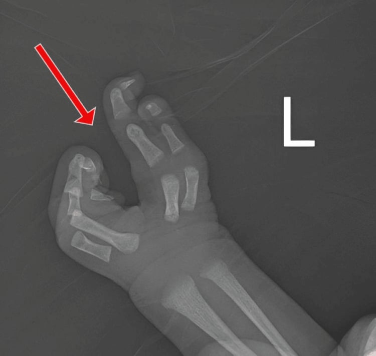 AP radiograph of a left neonatal hand with absent middle metacarpal and phalanges.