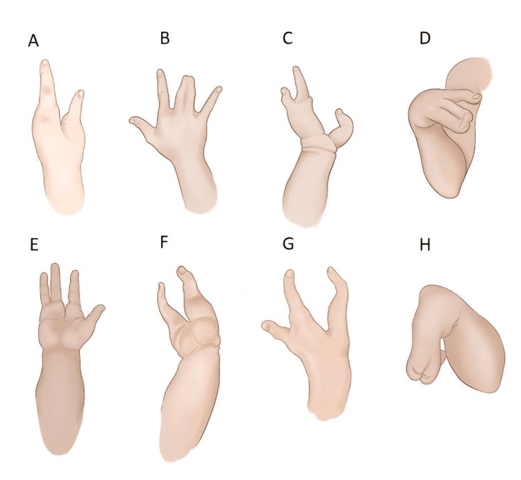 Eight schematic examples showing the phenotypic spectrum of split-hand malformation.