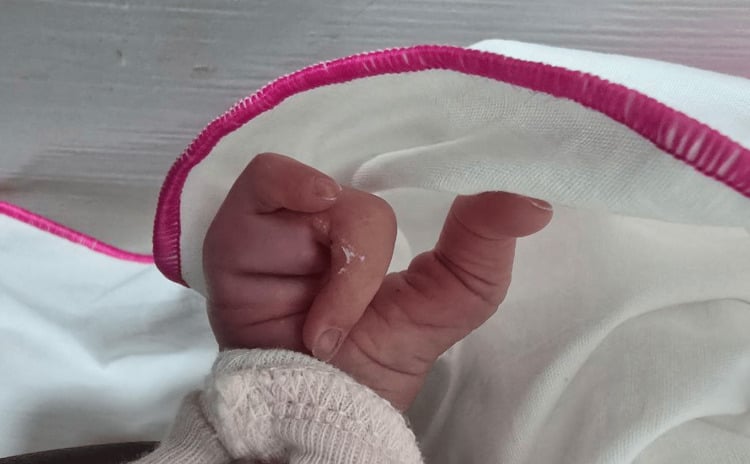 Right neonatal hand with absence of the index and middle digits and a deep central cleft.