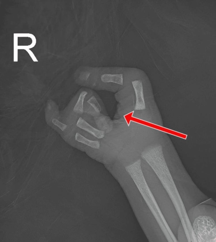 AP radiograph of a right neonatal hand with absent index and middle metacarpals and phalanges.