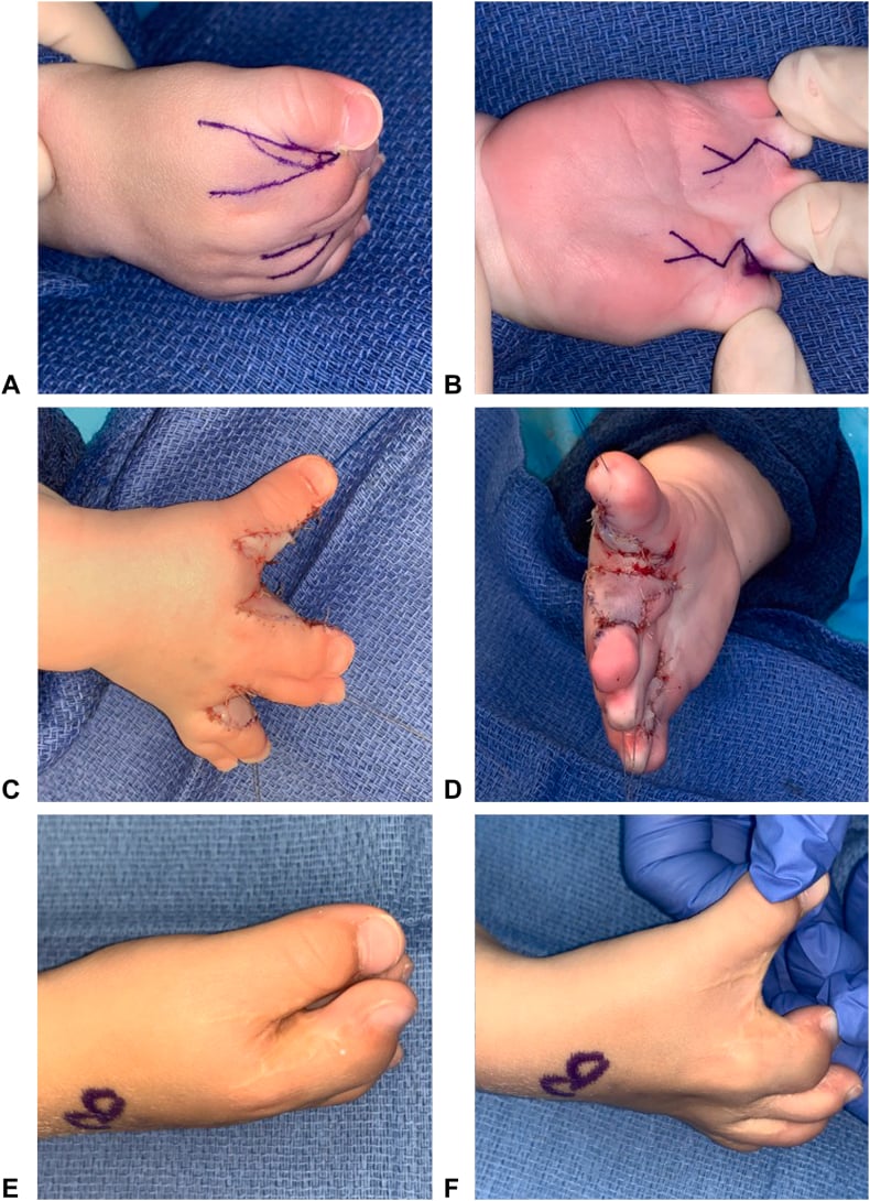 Six-panel sequence showing first-web flap markings, closure and postoperative views in a child who later required revision web deepening.