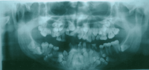 Orthopantomogram in cleidocranial dysostosis showing multiple unerupted and supernumerary teeth
