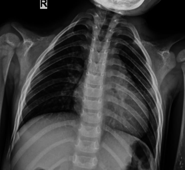 Frontal chest radiograph showing absent clavicles and a bell-shaped thorax