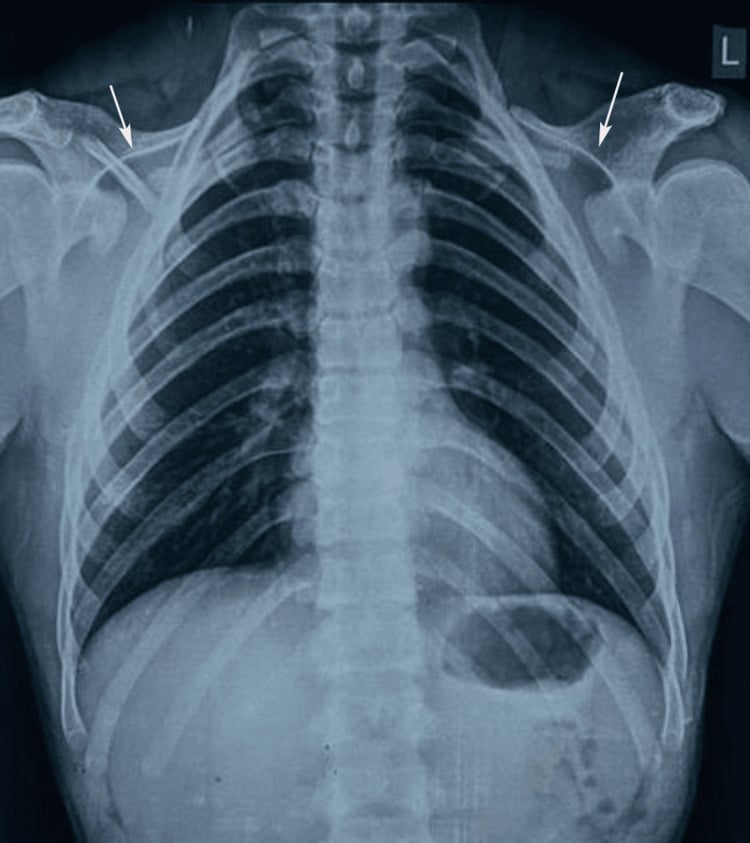 Chest radiograph showing bilateral clavicular hypoplasia