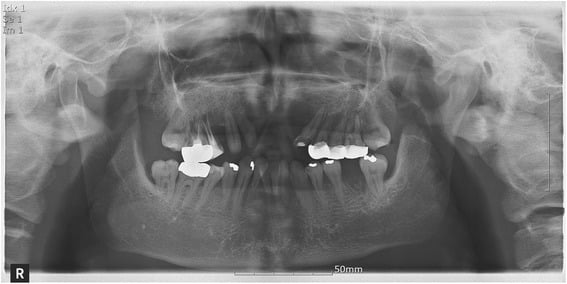 Panoramic radiograph showing a left mandibular coronoid-process fracture