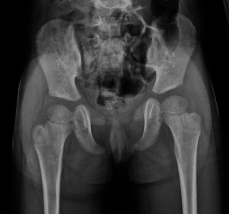 Pelvic radiograph showing absent pubic ossification and a wide symphysis