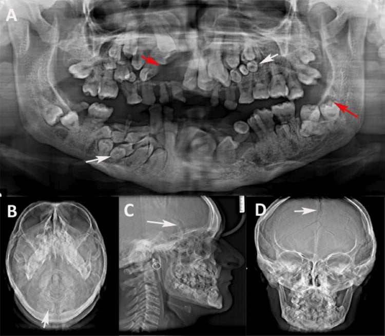 Panoramic dental and paranasal-sinus radiographs showing impacted and supernumerary teeth