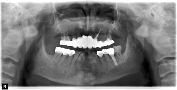 Panoramic radiograph after fixed prosthetic and implant rehabilitation