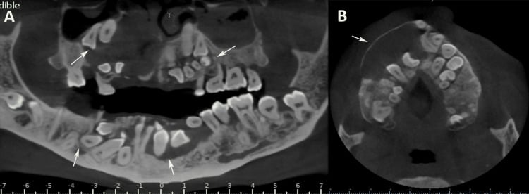 Panoramic and axial CBCT showing approximately forty-five impacted teeth