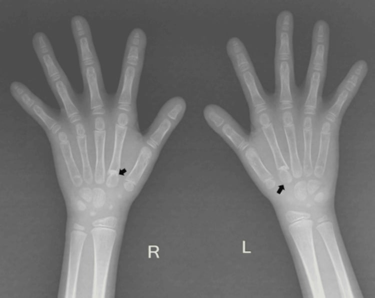 Bilateral hand radiograph showing distal phalangeal shortening and second-metacarpal pseudoepiphyses