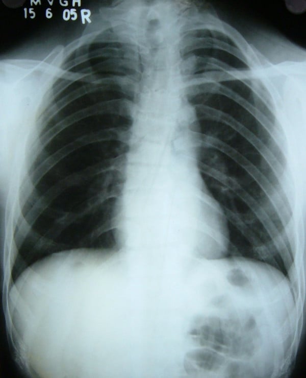 Chest radiograph showing thin hypoplastic clavicles and a bell-shaped rib cage
