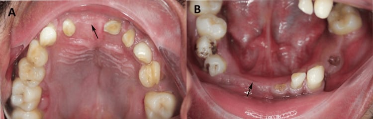 Intraoral views showing multiple clinically missing teeth in both arches