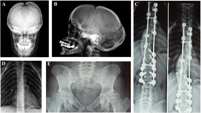 Composite radiographs showing skull, dental, spinal, clavicular and pelvic features