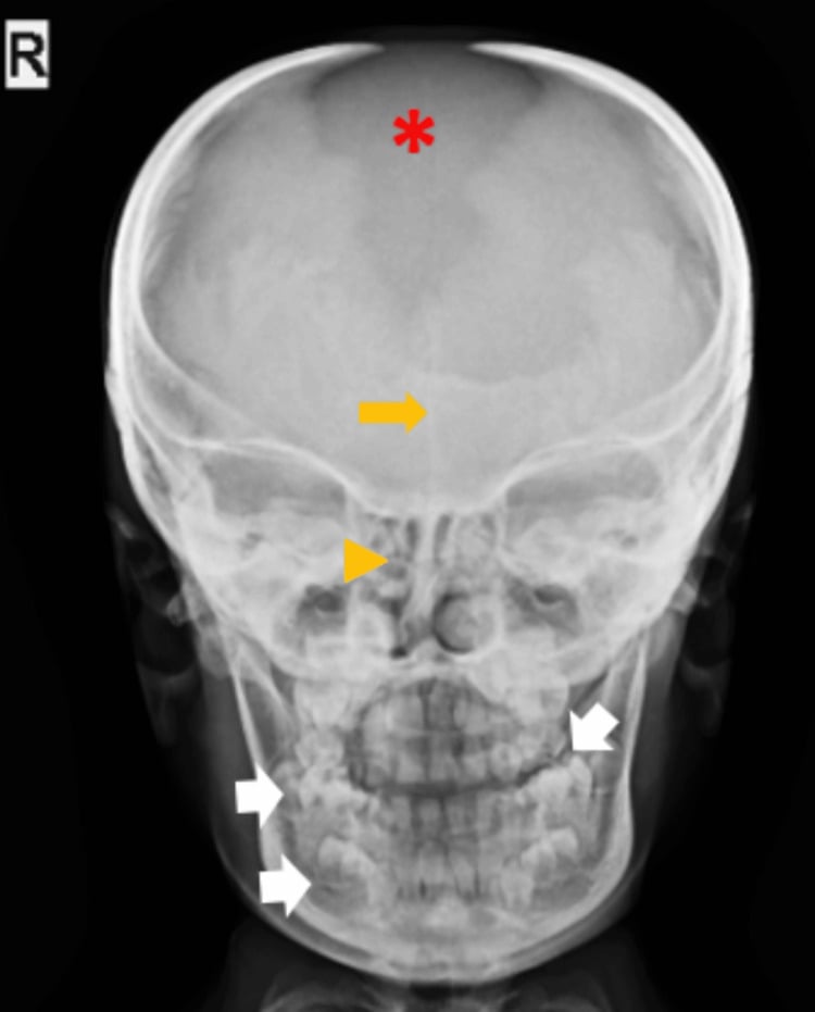 Frontal skull radiograph showing an open fontanelle, persistent metopic suture and supernumerary teeth