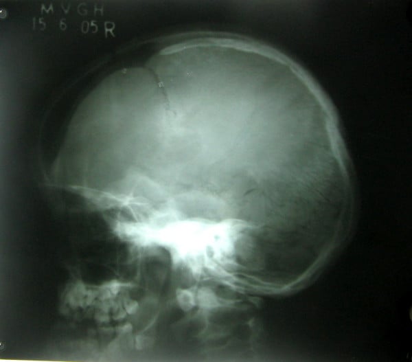 Lateral skull radiograph showing open sutures, large fontanelles and Wormian bones