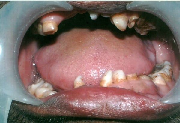 Intraoral view showing retained deciduous teeth and missing permanent teeth