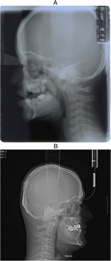 Serial lateral cephalograms at ages eleven and twenty-nine