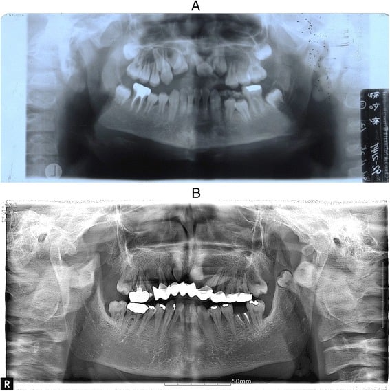 Serial panoramic radiographs at ages eleven and twenty-nine