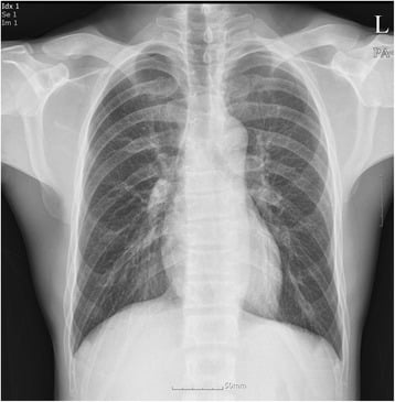 Chest radiograph showing short thick clavicles and a bell-shaped thorax