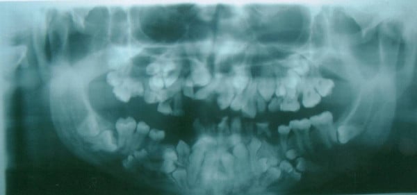 Panoramic radiograph showing multiple unerupted supernumerary teeth