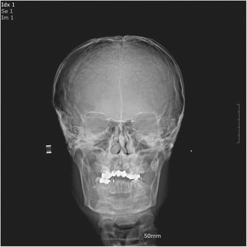 Posteroanterior cephalogram showing Wormian bones and absent frontal sinus