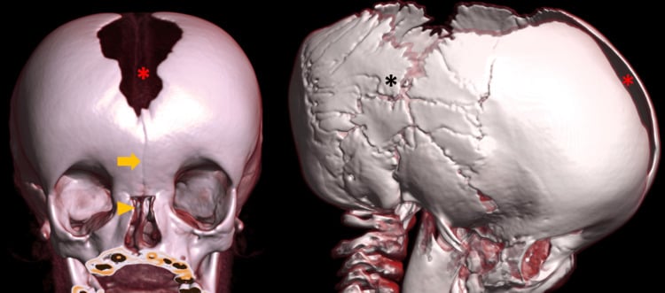 Volume-rendered skull CT showing open sutures, Wormian bones and a large fontanelle