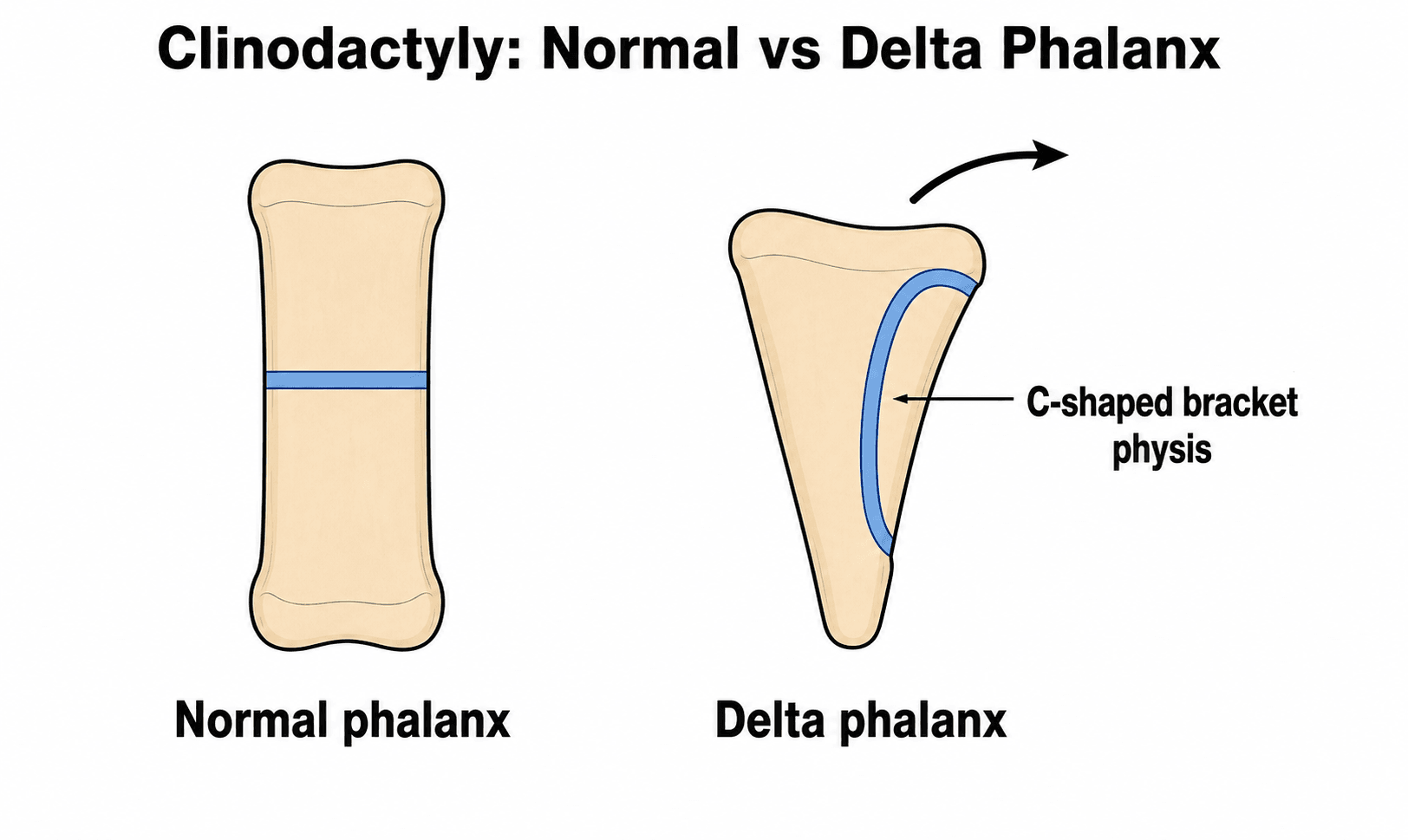 Diagram comparing a normal rectangular phalanx with a delta phalanx that has a C-shaped bracket epiphysis causing the finger to curve.