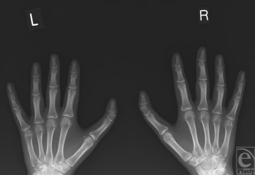 AP radiographs of both hands showing bilateral triphalangeal thumbs with a delta phalanx and coronal thumb deviation.