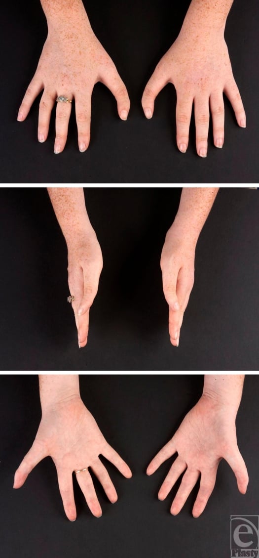 Dorsal, lateral and palmar clinical views of both hands showing bilateral triphalangeal thumbs with clinodactyly.